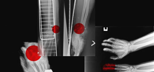 X-rays obtained by CNN